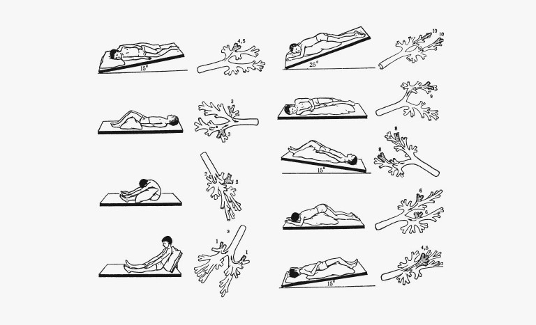 6-5-pastural-drenazh.jpg Постуральный дренаж: смена положений для отвода мокроты