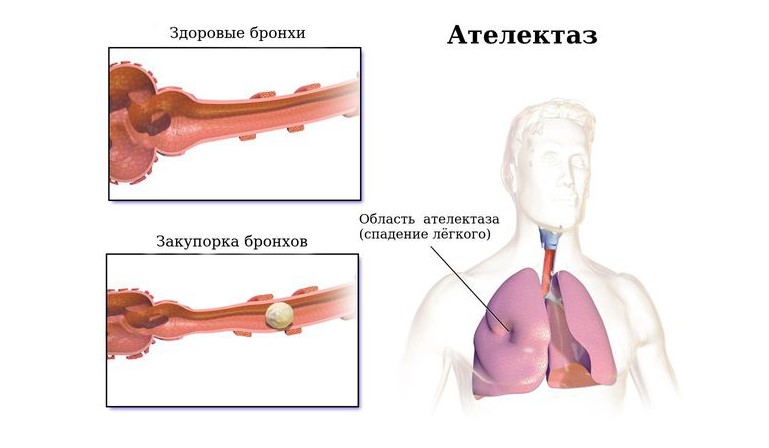 Правильный подбор маски важен для предотвращения утечек воздуха 