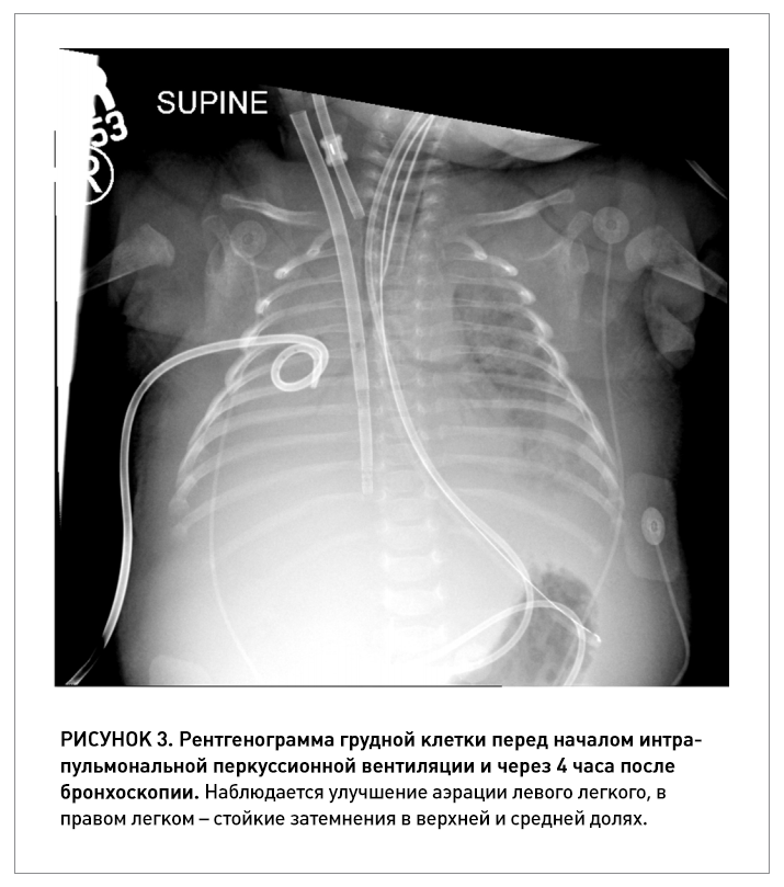ИПВ как метод очистки дыхательных путей во время ЭКМО у младенца с коклюшем