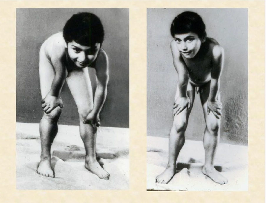 Прием Говерса при подъеме с пола — опора руками на колени и бедра