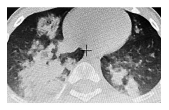 Современные подходы к диагностике и терапии липоидной пневмонии у детей